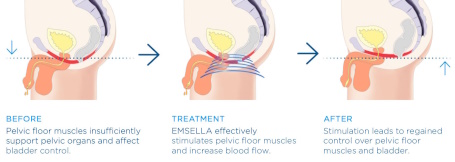Emsella Before, During & After Treatment